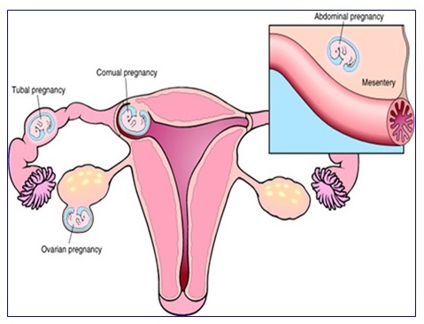 Dış Gebelik Nedir?